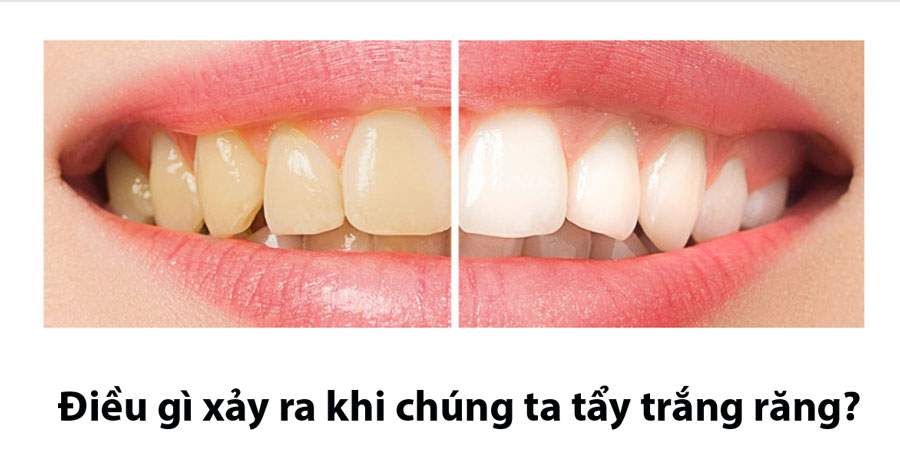 tẩy trắng răng, có nên tẩy trắng răng, làm trắng răng,
